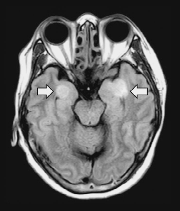 Scanner-cerveau-covid-19